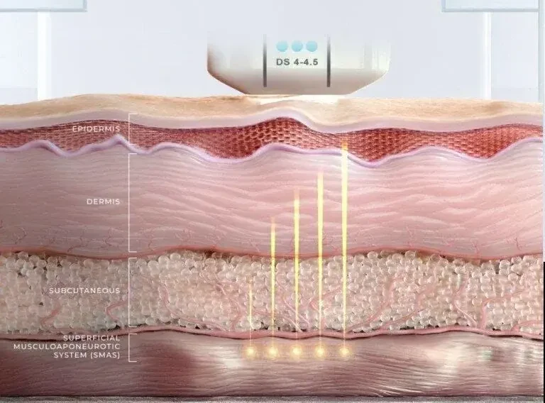 Diagrama de las capas de la piel (epidermis, dermis, tejido subcutáneo y SMAS) con el aplicador de Ultherapy PRIME